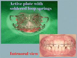 Lingual Orthodontics