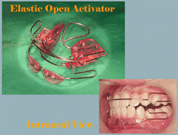 Lingual Orthodontics