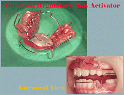 Lingual Orthodontics